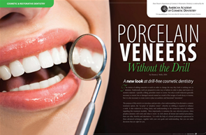 No-prep Procelain Veneers - Dear Doctor